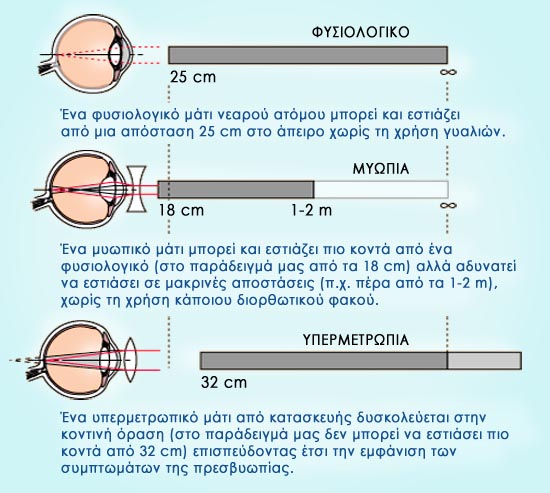myopia9